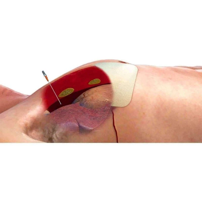 ars for needle decompression vendor 2