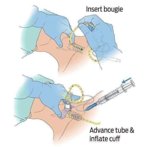 bougie aided cricothyroidotomy pack bac packtm vendor 7